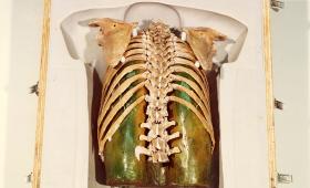 Rib cage attached to the soluble organ cavity mold and positioned inside the hollow torso silicone mold. 